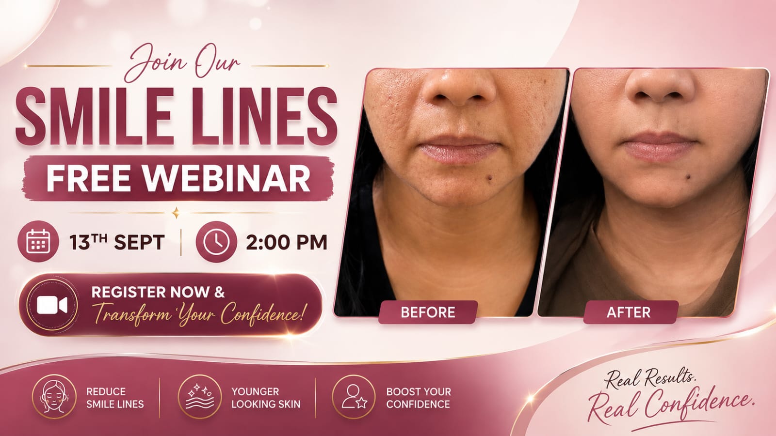 Free Smile Lines Webinar