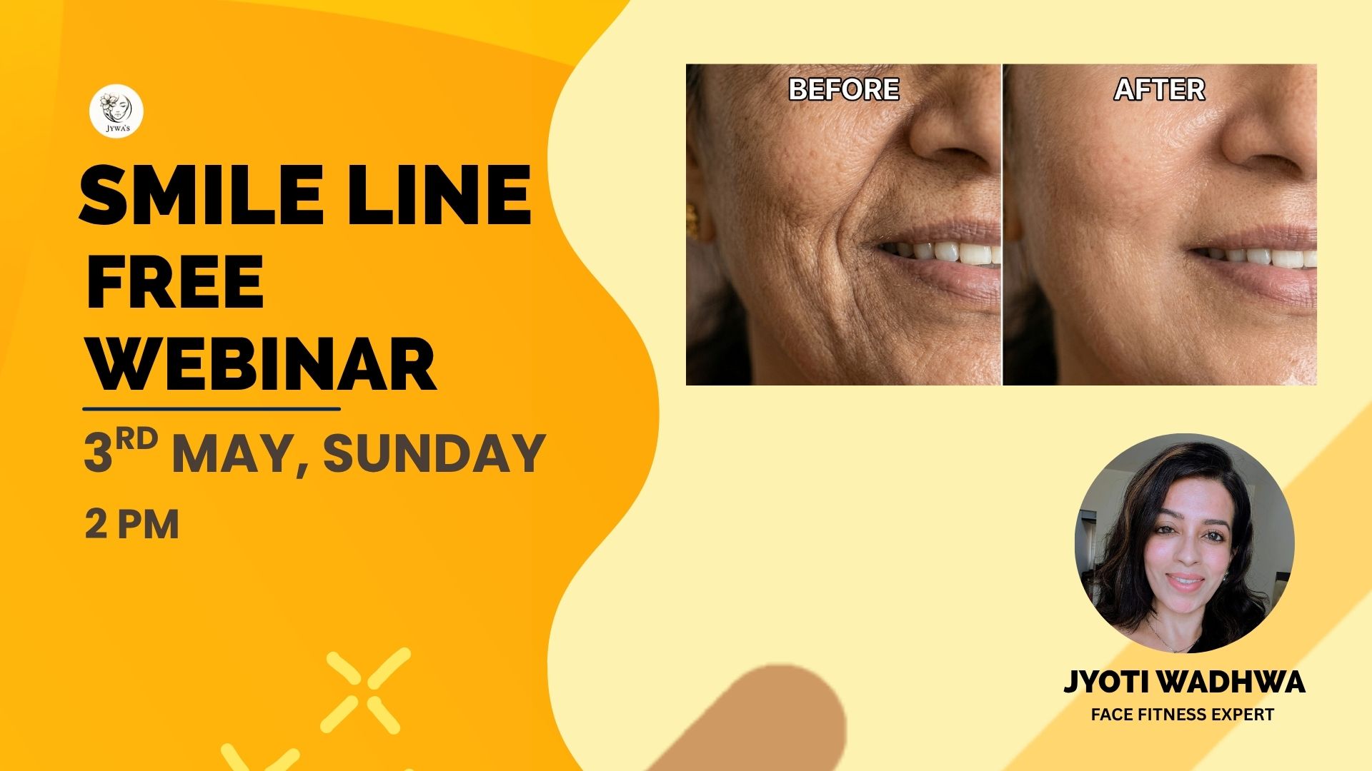 Smile line